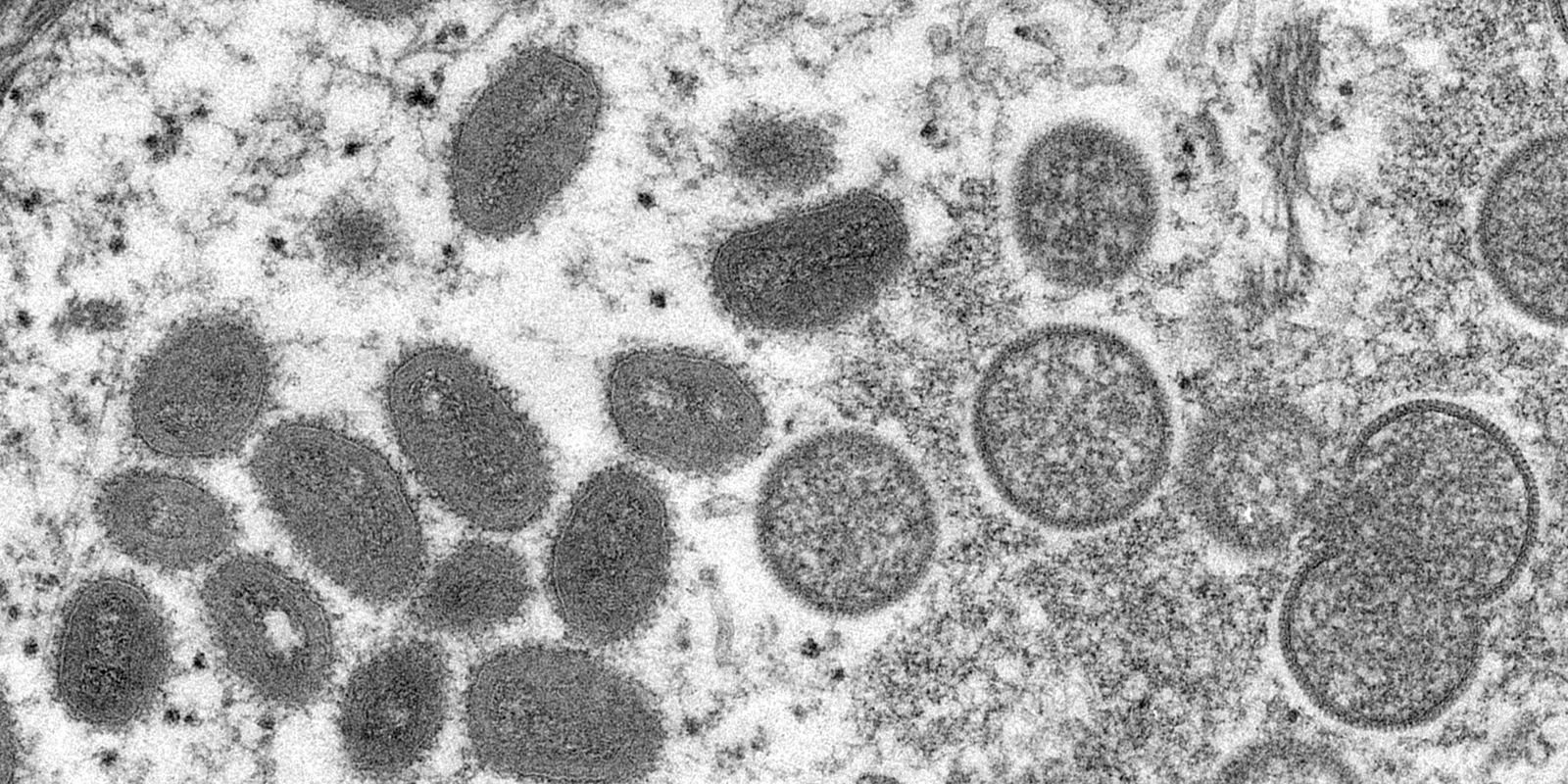 Macaé investiga suspeita de varíola dos macacos